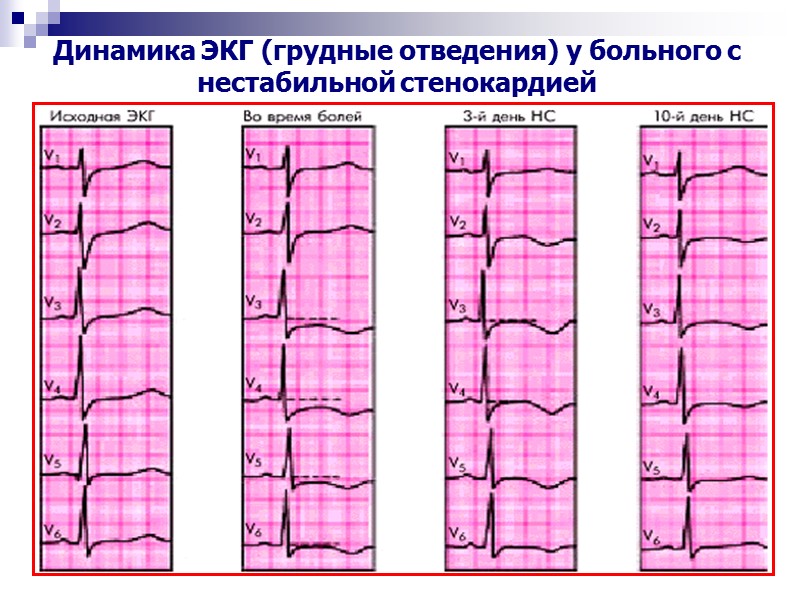 Динамика ЭКГ (грудные отведения) у больного с нестабильной стенокардией
